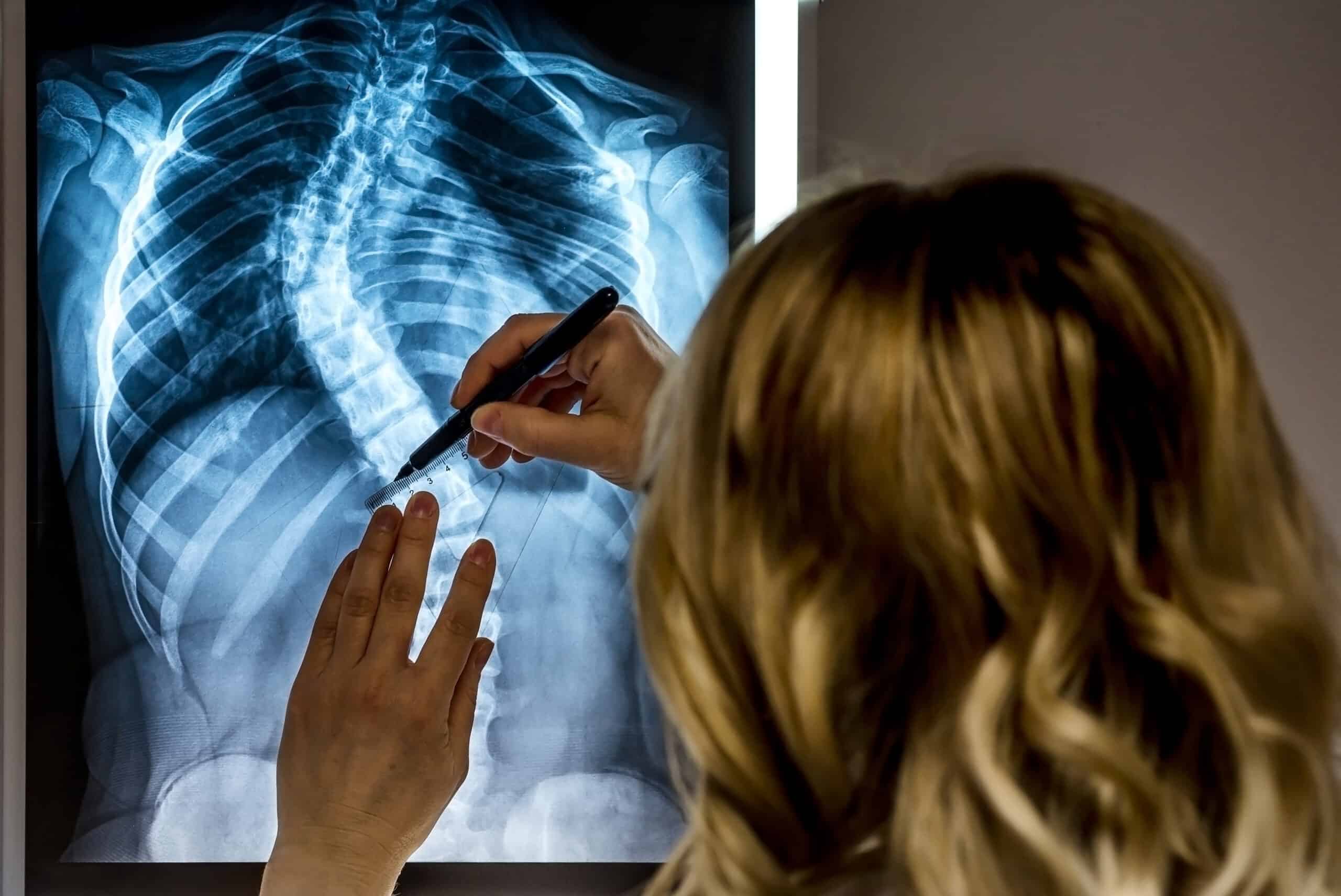 Blonde female physician looking at a patients x-ray. Scoliosis specialist Doctor making measurements at the patients X-Ray