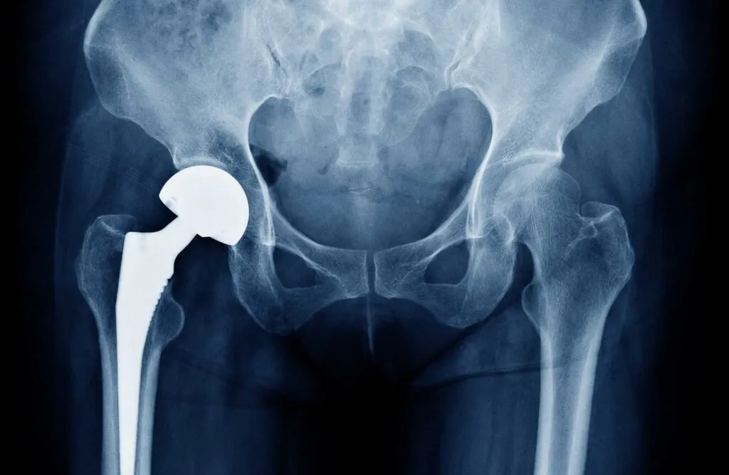 An x-ray still of a hip replacement