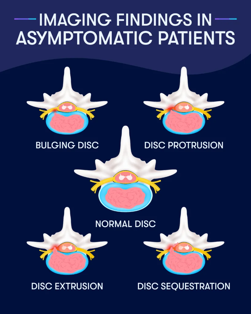 a chart showing the specific types of bulges in spinal discs