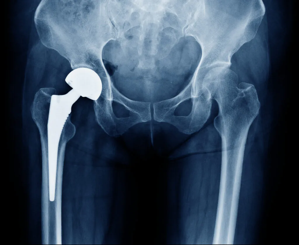 X-ray scan image of hip joints with orthopedic hip joint replacement or total hip prosthesis on right side implant head and screws in human skeleton in blue gray tones.